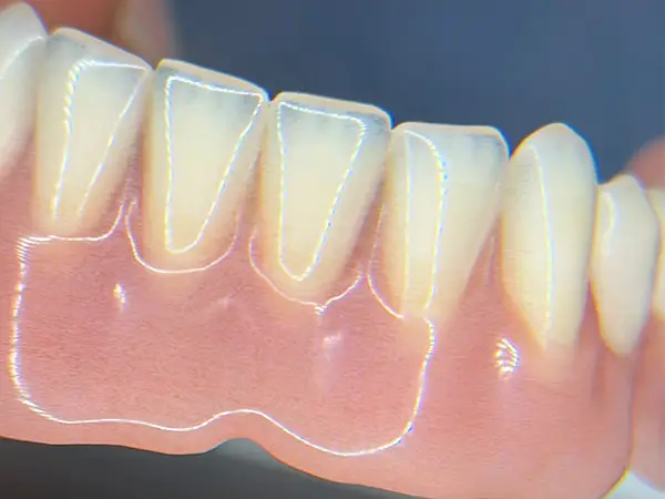Zahntechnische Prothese — Dampfstrahler Dentallabor